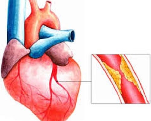 4 thói quen xấu khiến người trẻ dễ bị nhồi máu cơ tim- Ảnh 1.