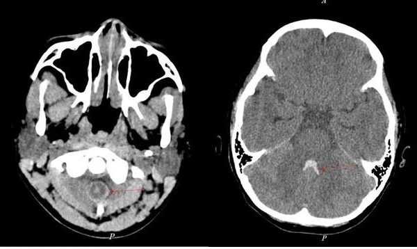 Trẻ 10 tuổi bị xuất huyết não, làm gì để phát hiện sớm căn bệnh này?- Ảnh 1.