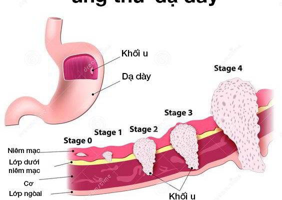 Người đàn ông tử vong sau 3 tuần uống nước kiềm chữa ung thư dạ dày, bệnh này điều trị thế nào?- Ảnh 1.