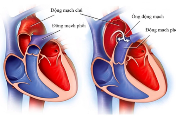 Vụ tử vong sau thay van động mạch chủ qua da: BV Bạch Mai đang làm rõ 3 bác sĩ tham gia - Ảnh 1.