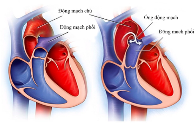 Vụ tử vong sau thay van động mạch chủ qua da: BV Bạch Mai đang làm rõ 3 bác sĩ tham gia - Ảnh 1.